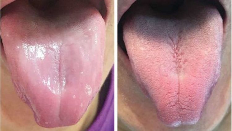 Езикът на пациент става напълно гладък, сякаш е изгубил вкусовите си папили